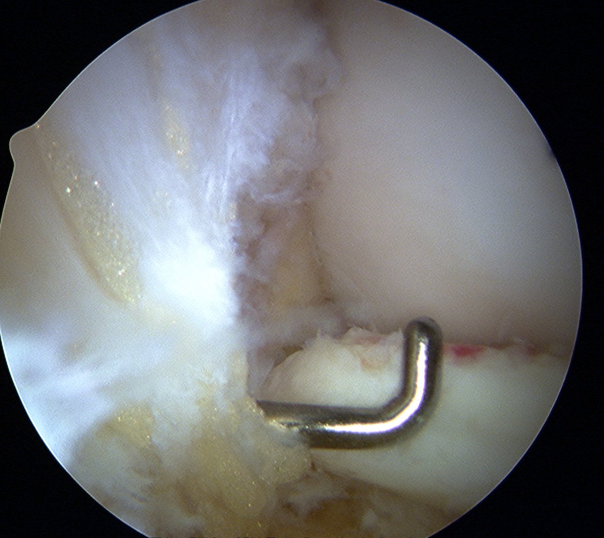 Femoral OCD Reduction